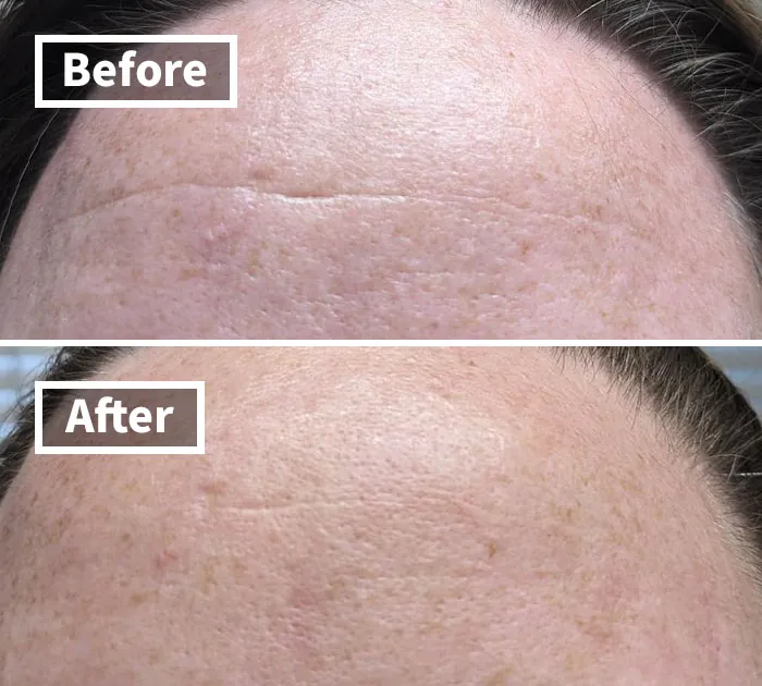When Your 'I'm Just Concentrating' Face Has Decided To Become Your Permanent Face, Some <a Style="Display:inline;" Href="Https://Www.amazon.com/Frownies-Forehead-Between-Eyes-Patches/Dp/B00027dmsi?ie=utf8&linkcode=ll1&tag=bpfish-20&linkid=7547f64fe107762cbb4b825ba7048db2&language=en_us&ref_=as_li_ss_tl" Target="_blank">    <span Style="Font: Inherit; Color: #d74b1f;"> Forehead And Between The Eyes Facial Patches </Span> Can Help It Take A Vacation