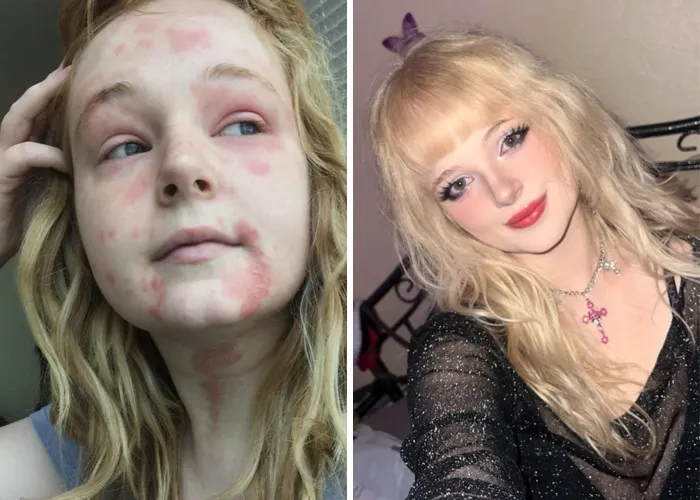 19-25! Got Treatment For My Autoimmune Issues And Developed Love For Cool Makeup!