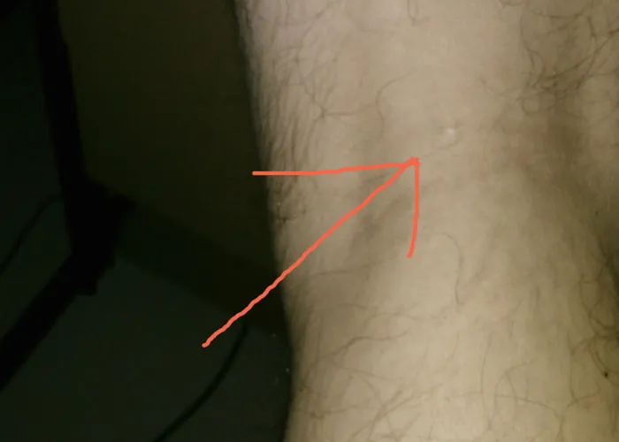 Close-up of a leg with an arrow drawn in red, highlighting an unusual mark as part of unbelievable experiences people share.