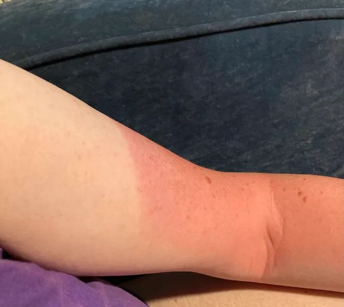 The Bad Sunburn That I Stupidly Got Because I Got Distracted Before I Left To An Event At The Beach And Thought I'd Already Put On Sunburn. I Hadn't. The Backs Of My Calves Where My Shorts End Also Got Badly Sunburned. As Did The Backs Of My Hands. Summer In Southern California, Yay!