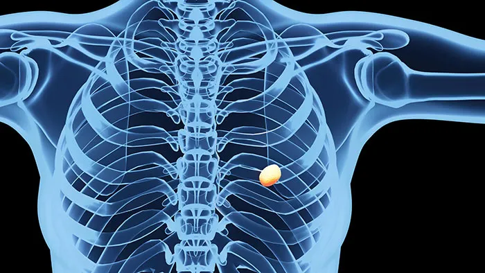 3D illustration of human ribcage showing a small highlighted flaw within the upper torso structure of the human body.