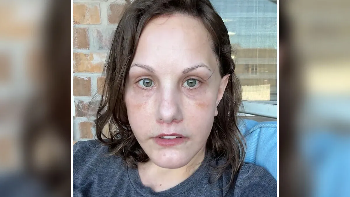 "I Still Don’t Recognize Myself": Woman's $15K Facelift Results Break The Internet 