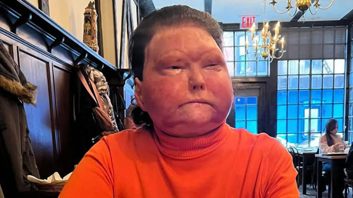 Face And Hand Transplant Recipient Stunned Doctors With What He Felt During Medically Induced Coma