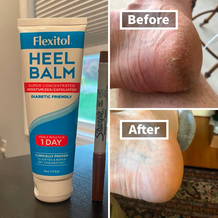 Those Cracked Heels That Look Like They've Seen Better Millennia Can Get A Major Hydration Boost With The Minimal Effort Of Applying <a Style="Display:inline;" Href="Https://Www.amazon.com/Flexitol-Moisturizing-Exfoliating-Pedicures-Effective/Dp/B0013h8m5e?crid=1cw1gt93fi69e&dib=eyj2ijoimsj9.xyf9uzjsqqy_vgrjvh0zibnp8kvvft4whpncag-Sa6vhx1mxq1nvsgbd-PC6nakhm4h9ylzhxhhme5lhlqoxjpfzz6rzphlhfgxnxaobyemghzdlhk7nk1yhfatzcwohlar9a6pfty4-Tve2xz8krabk2nv9orww5smruroxfthbuzlmp7o5fodswjqn87bkwnpihjgd1pwoiwkp-Zzwtpngdfo16i2sxahsdfriieojmmjyk8dp44i5guniryizpufokgg9bgaurgmc0a_irurodgtqij6z9ka4jshaxtk.xrtnillbikyhcxiasfaq6tq4af57axf4vkpzieapboq&dib_tag=se&keywords=heel%2bbalm&qid=1729850545&rdc=1&sprefix=heel%2bbalm%2caps%2c204&sr=8-2-Spons&sp_csd=d2lkz2v0tmftzt1zcf9hdgy&th=1&linkcode=ll1&tag=bpgorilla-20&linkid=36e71e39c01fe69c9e903ff34c1abb45&language=en_us&ref_=as_li_ss_tl" Target="_blank"><span Style="Font: Inherit; Color: #d74b1f;"> Flexitol Heel Balm</Span> For Maximum Softness And Sandal-Readiness