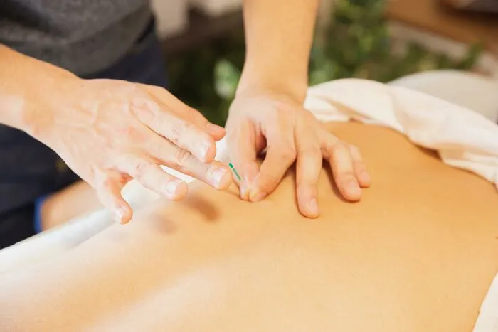 Hands performing acupuncture treatment on a person's back, illustrating people still falling for fictional health myths.
