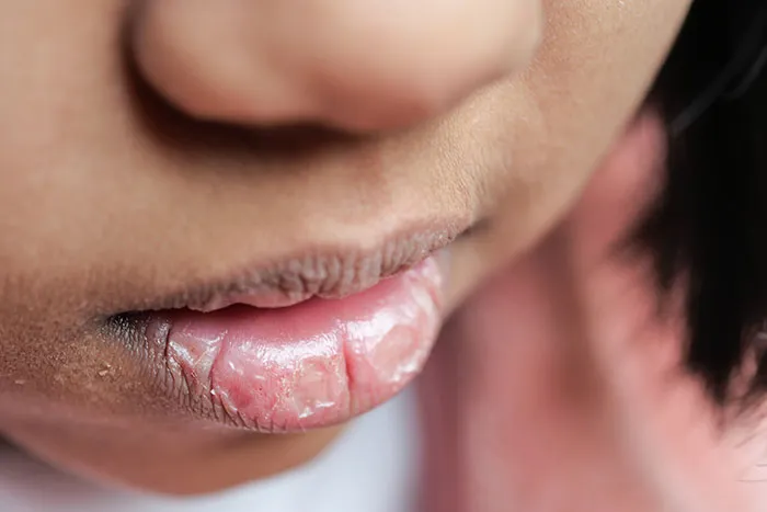 Close-up of a child's lips showing dryness and cracking illustrating kids' lies that started off silly and got serious.