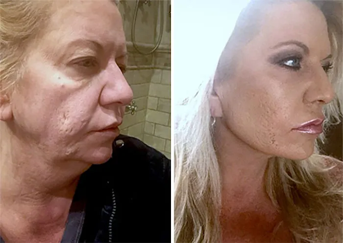 Mujer antes y después mostrando resultados positivos de cirugía plástica sin arrepentimientos ni signos visibles de cicatrices.