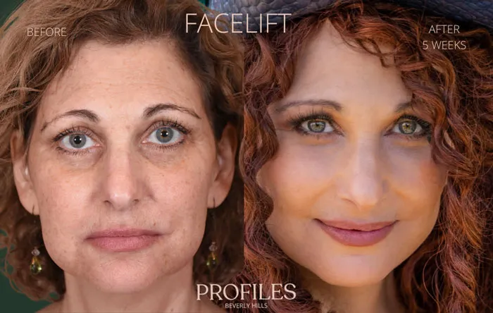Mujer antes y después de cirugía plástica de lifting facial, mostrando resultados visibles y naturales en su rostro.