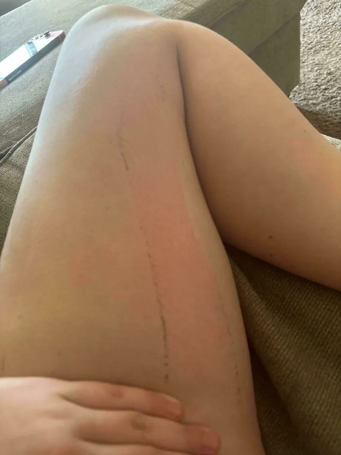 Leg showing red marks and ink lines from forgetting something, illustrating funny unfortunate situations involving people.
