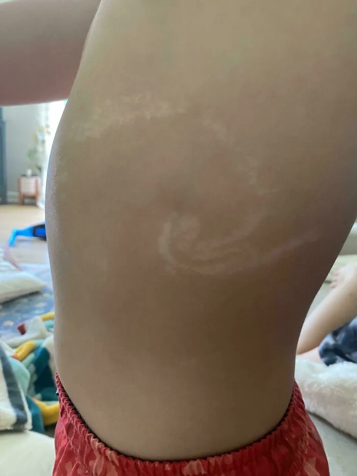 Close-up of a person's side torso showing a mild interesting spiral-shaped sunburn pattern on the skin.
