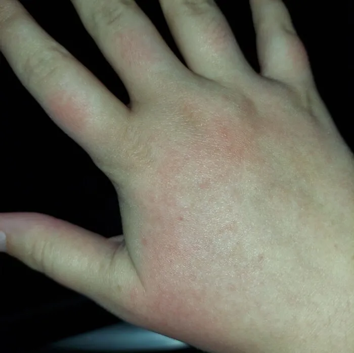 Mi jefe no me creyó cuando le dije que soy alérgico al látex y que no puedo usar los guantes nuevos que compró.