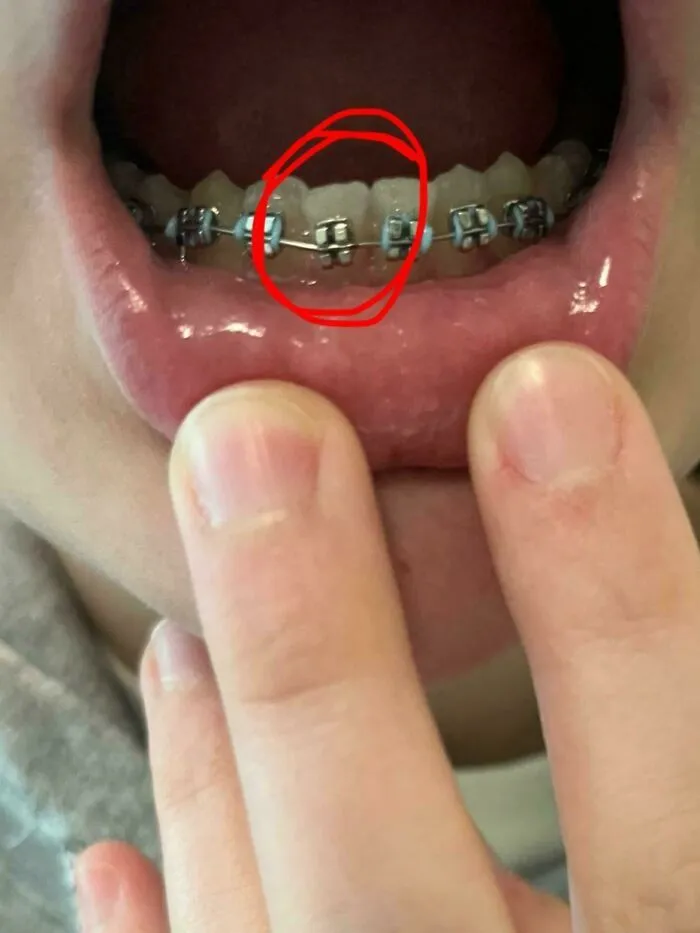 Close-up of lower teeth with braces showing a missing bracket circled in red, illustrating a funny unfortunate situation.
