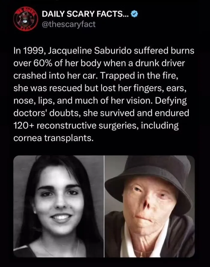 Before and after photos showing a woman who survived severe burns and underwent 120+ reconstructive surgeries, scary fact included.