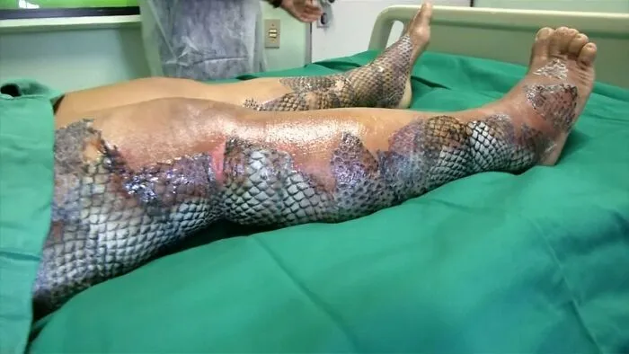 La piel de pescado se utiliza para tratar a las víctimas de quemaduras
