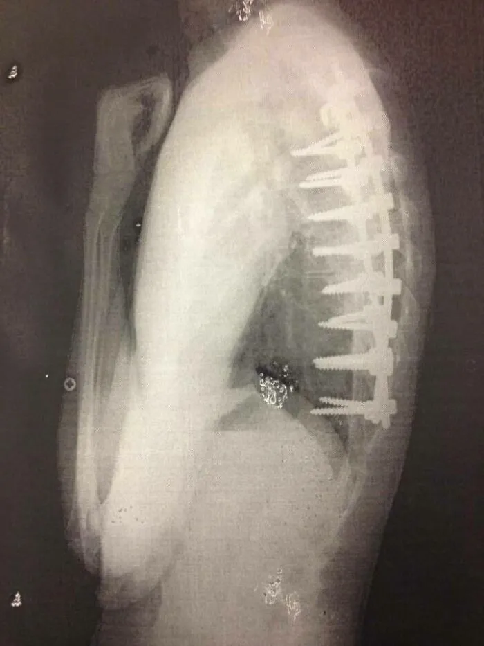 En mi cabeza, los tornillos de mi cirugía de fusión espinal parecían mucho más pequeños