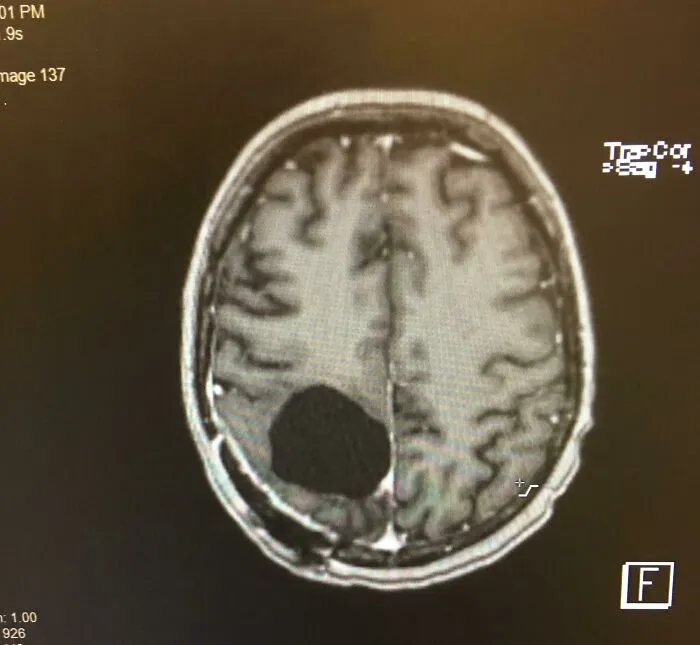 Me extirparon un tumor cerebral y ahora estoy un poco ausente