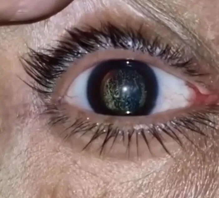 La hialosis asteroidal es una condición médica en la que los ojos de la persona se ven como el universo.