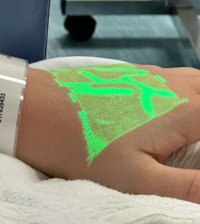 This Device To Help Medical Professionals Find Veins. The Veinviewer