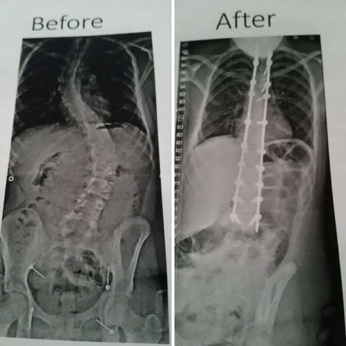 Antes y después de una fusión espinal total