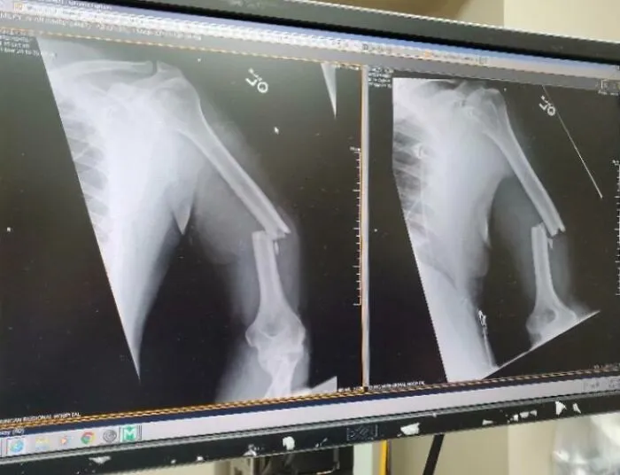 El brazo de mi padre (de casi 60 años) después de que una vaca lo golpeara esta mañana