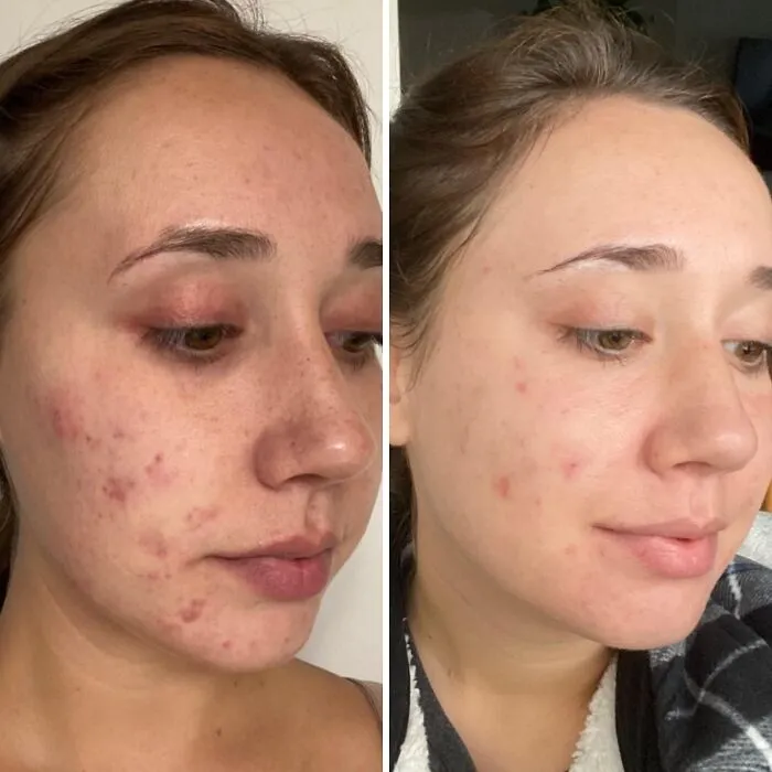 That Pimple Living Rent-Free On Your Chin Is About To Get A Serious Eviction Notice From <a Style="Display:inline;" Href="Https://Www.amazon.com/Differin-Adapalene-0-1-Acne-Treatment/Dp/B07l1phsy9?ie=utf8&th=1&linkcode=ll1&tag=bprat-20&linkid=8a4f2768ac8fc14f879be13d817ffccb&language=en_us&ref_=as_li_ss_tl" Target="_blank">  <span Style="Font: Inherit; Color: #d74b1f;"> Differin Acne Treatment Gel </Span>