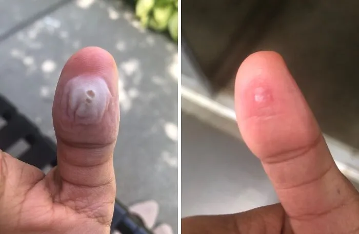 That Freeloader On Your Skin Who Refuses To Pay Rent Is About To Be Sent Packing With <a Style="Display:inline;" Href="Https://Www.amazon.com/Compound-Step-Pads-Salicylic-Remover/Dp/B000qwlozw?ie=utf8&th=1&linkcode=ll1&tag=bprat-20&linkid=73065bd4c00d0dffbaeb190eb537a7a8&language=en_us&ref_=as_li_ss_tl" Target="_blank">  <span Style="Font: Inherit; Color: #d74b1f;"> Compound W Wart Remover </Span>