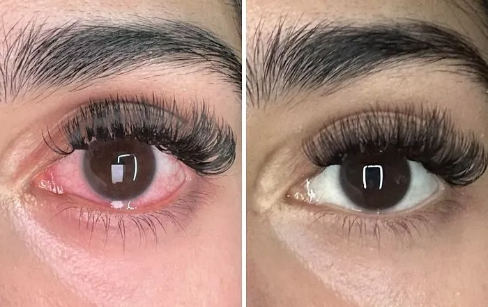 Your Eyes Can Stop Snitching On How Little Sleep You Got Last Night With A Little Help From <a Style="Display:inline;" Href="Https://Www.amazon.com/Lumify-Redness-Reliever-Drops-2-5ml/Dp/B07cdn39dp?ie=utf8&linkcode=ll1&tag=bprat-20&linkid=62bd062a3974c90654ac0ab087225ffe&language=en_us&ref_=as_li_ss_tl" Target="_blank">  <span Style="Font: Inherit; Color: #d74b1f;"> Lumify Eye Drops For Red Eyes </Span>