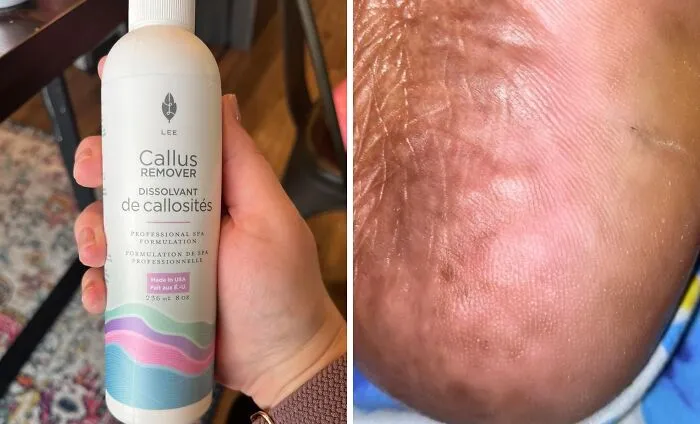 Your Poor Bedsheets Won't Have To Suffer The Wrath Of Your Scratchy Heels Anymore With A Good <a Style="Display:inline;" Href="Https://Www.amazon.com/Callus-Remover-Callus-Eliminator-Professional-Electric/Dp/B0787mth4t?ie=utf8&th=1&linkcode=ll1&tag=bprat-20&linkid=ff8366353fe520210b34eacff77a3670&language=en_us&ref_=as_li_ss_tl" Target="_blank">  <span Style="Font: Inherit; Color: #d74b1f;"> Callus Remover </Span>