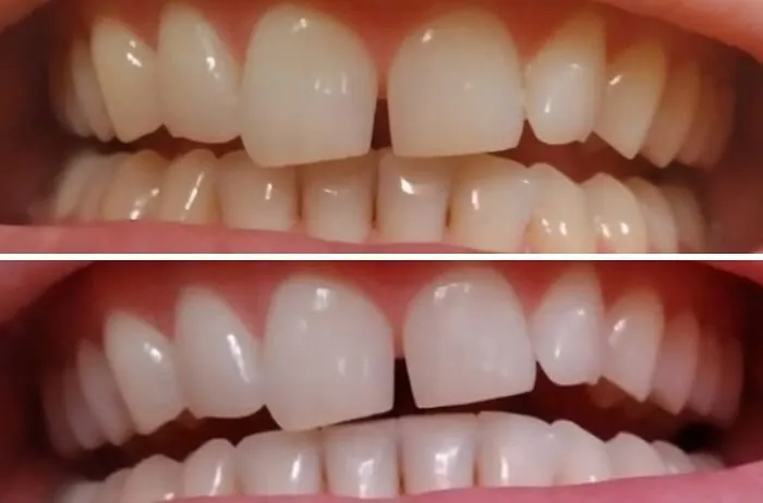 Your Teeth Can Stop Looking Like They're Sponsored By Your Local Coffee Shop With Some <a Style="Display:inline;" Href="Https://Www.amazon.com/Whitening-Sensitive-Whitener-Whitestrip-Technology/Dp/B0dhl1hbdx?pd_rd_w=ylbm9&content-ID=amzn1.sym.9023959a-379f-4911-BF85-9afa60b85373&pf_rd_p=9023959a-379f-4911-BF85-9afa60b85373&pf_rd_r=ft2pxqjd2ktjnvnh7eam&pd_rd_wg=v19jr&pd_rd_r=531ac623-Fba9-4f5b-A217-0c89a2d076c3&pd_rd_i=b0dhl1hbdx&th=1&linkcode=ll1&tag=bprat-20&linkid=f6e6236e8b0c0fae467f8b828525d6f6&language=en_us&ref_=as_li_ss_tl" Target="_blank">  <span Style="Font: Inherit; Color: #d74b1f;"> Teeth Whitening Strips </Span>