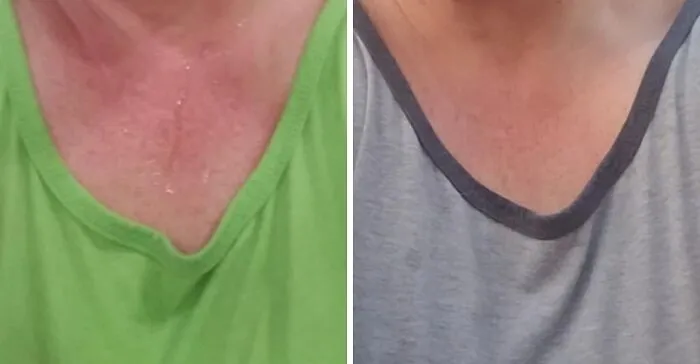 Your Shirt Doesn't Have To Betray Your Trust And Expose Your Nerves To The Whole World With Some <a Style="Display:inline;" Href="Https://Www.amazon.com/Sweatblock-Antiperspirant-Clinical-Strength-Reduce/Dp/B002pq8bqm?ie=utf8&th=1&linkcode=ll1&tag=bprat-20&linkid=f778231d999501249eff3d45ef748dab&language=en_us&ref_=as_li_ss_tl" Target="_blank">  <span Style="Font: Inherit; Color: #d74b1f;"> Clinical Strength Antiperspirant Wipes </Span>