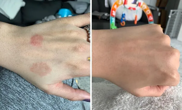 All The Dramatic, Itchy Flare-UPS On Your Skin Can Be Told To Take A Major Chill Pill, Courtesy Of A <a Style="Display:inline;" Href="Https://Www.amazon.com/Strength-Athletes-Treatment-Ringworm-Powered/Dp/B00yi2s0p8?ie=utf8&linkcode=ll1&tag=bprat-20&linkid=923761eb84c9b589f15d41910364fe2b&language=en_us&ref_=as_li_ss_tl" Target="_blank">  <span Style="Font: Inherit; Color: #d74b1f;"> Tea Tree Oil Balm </Span>