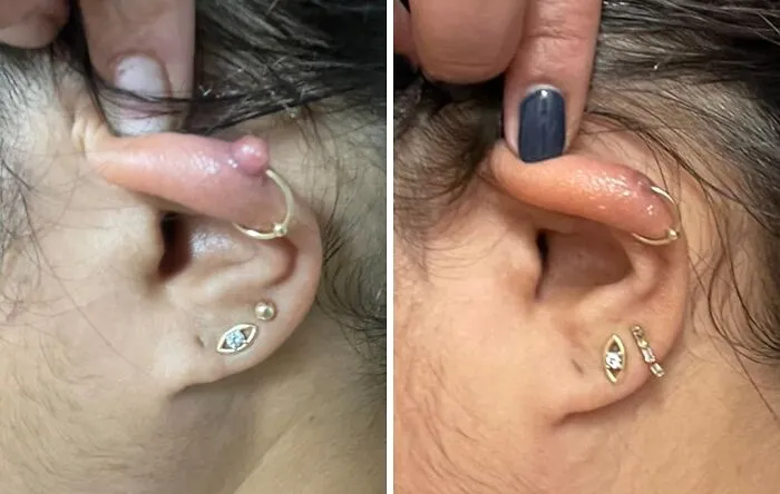 The Angry Little Bump Trying To Steal The Spotlight From Your Cool New Piercing Can Be Gently Escorted Off The Premises By A <a Style="Display:inline;" Href="Https://Www.amazon.com/Piercing-Treatment-Removal-Soothing-Aftercare/Dp/B09qh56drc?ie=utf8&th=1&linkcode=ll1&tag=bprat-20&linkid=e3de8a24bebb1c66c2c6ee55c4692d79&language=en_us&ref_=as_li_ss_tl" Target="_blank">  <span Style="Font: Inherit; Color: #d74b1f;"> Piercing Bump Solution & Keloid Bump Removal </Span>