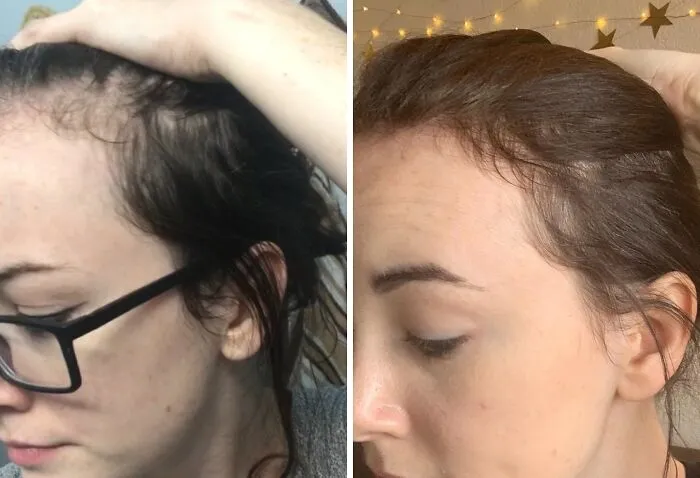 The Hair That's Been Threatening To Leave You Might Just Decide To Stick Around With Some <a Style="Display:inline;" Href="Https://Www.amazon.com/Biotin-Hair-Shampoo-Thinning-Moisturizing/Dp/B01encboa0?ie=utf8&th=1&linkcode=ll1&tag=bprat-20&linkid=8200093fdd387b276a49fd2fef6d8072&language=en_us&ref_=as_li_ss_tl" Target="_blank">  <span Style="Font: Inherit; Color: #d74b1f;"> Rosemary And Biotin Shampoo For Thinning Hair </Span>