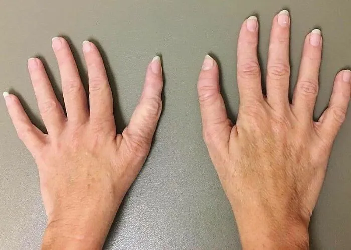 El pulgar trifalángico (TPT) es una malformación congénita en la que el pulgar tiene tres falanges en lugar de dos.