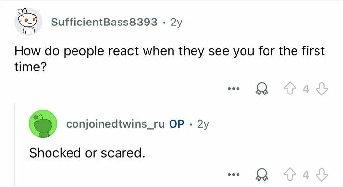 Conjoined Twins Answer 24 People’s Most Interesting And Burning Questions
