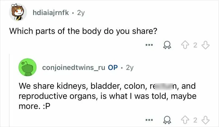 Conjoined Twins Answer 24 People’s Most Interesting And Burning Questions