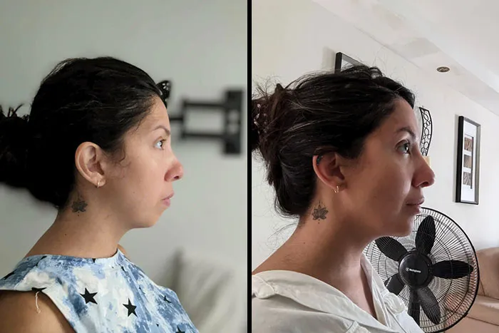 I Did It! Chin Filler Before And After