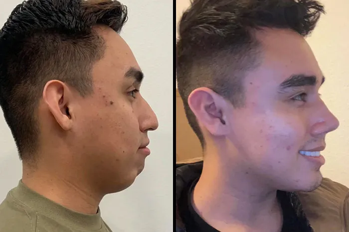 Genioplasty/Rhinoplasty