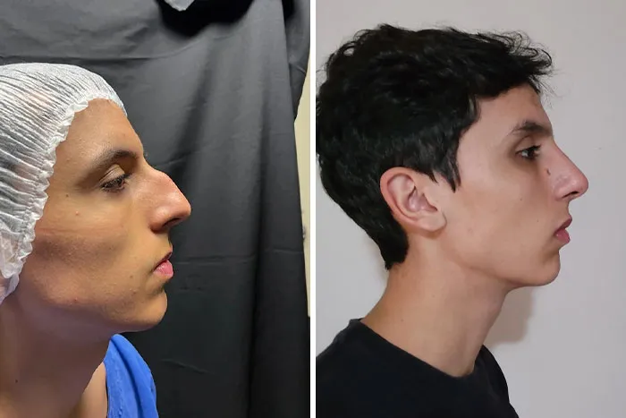 Results After 4 Weeks Of My Rhinoplasty, I Have Never Felt So Good About My Appearance 😃