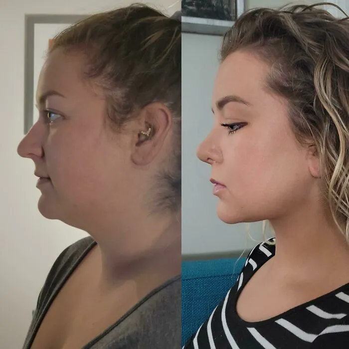 2 semanas después de la operación de rinoplastia y liposucción submental
