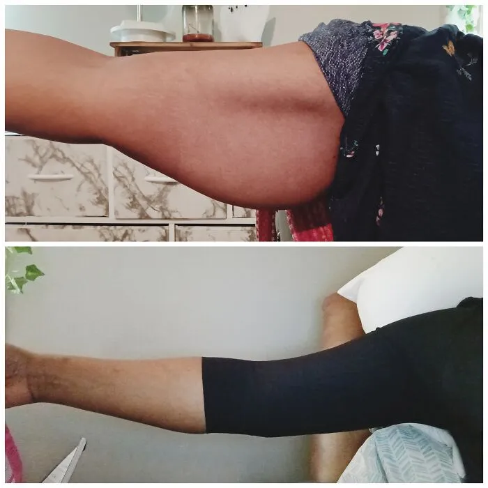 Antes y después del cambio en el brazo de una persona, mostrando resultados de cirugía plástica visibles y transformación notable.