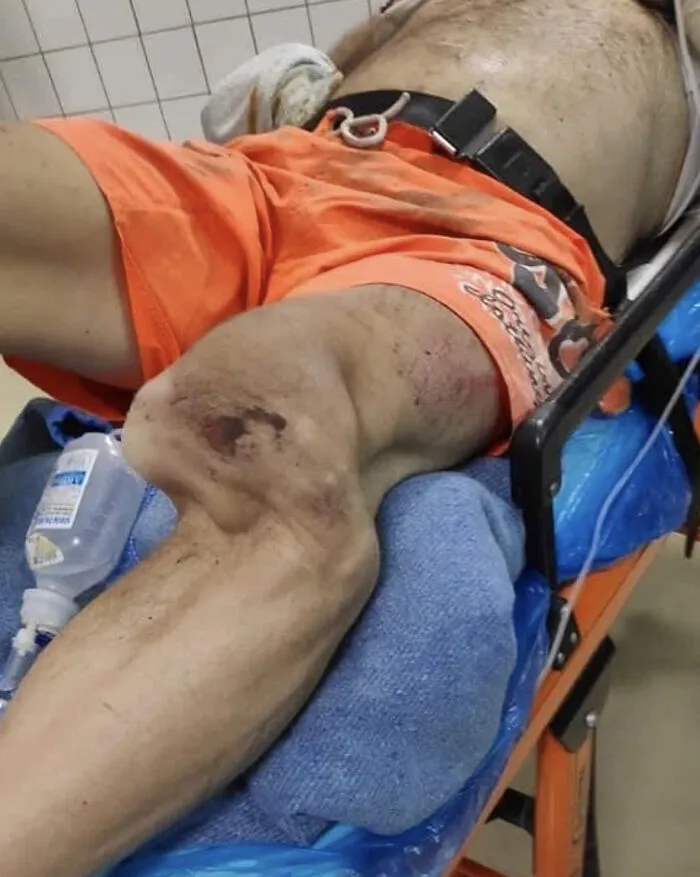 Severe Knee Dislocation Following Motorbike Accident