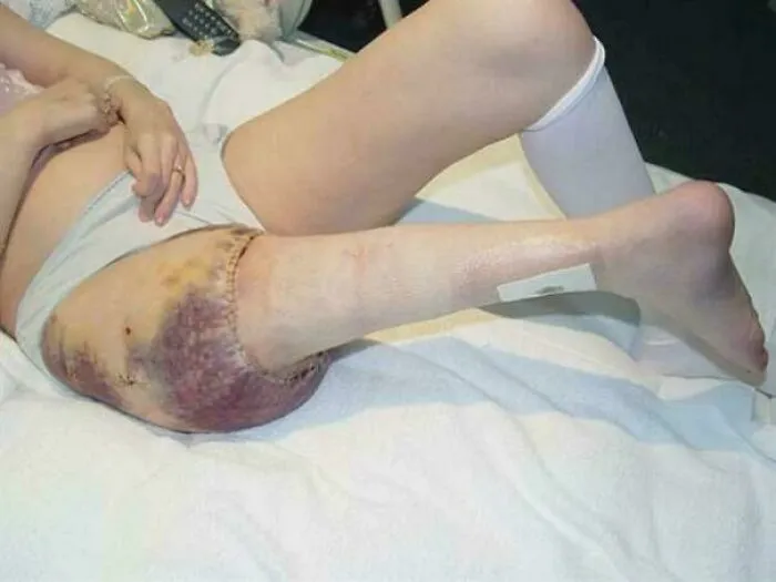 La plastia rotatoria es una cirugía para el cáncer de hueso cerca de la rodilla.
