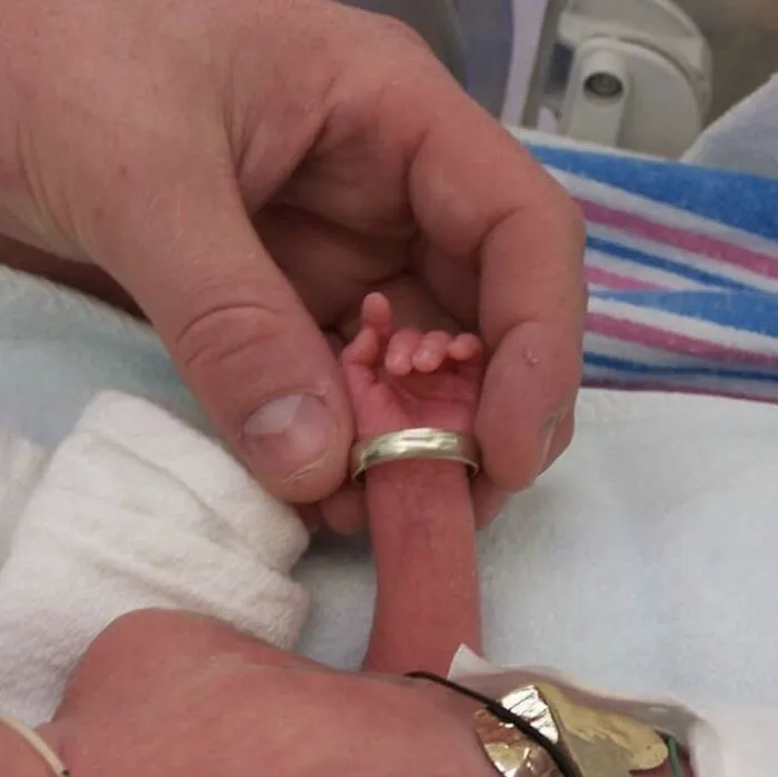 Un bebé prematuro nació tan pequeño que el anillo de bodas de su padre le quedaba perfecto en el antebrazo. El bebé pesó 700 gramos y nació prematuro a las 26 semanas mediante cesárea de emergencia.
