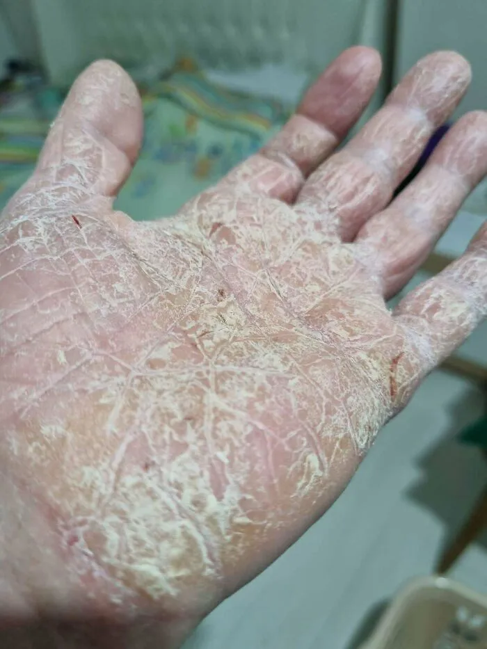 Mano con piel muy seca y agrietada mostrando una condición médica impactante en fotos médicas fascinantes y desconcertantes.