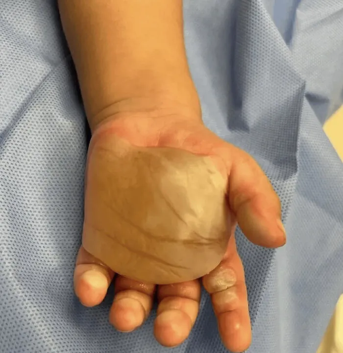 Una gran ampolla se formó después de que el bebé de 15 meses entró en contacto con una parrilla caliente (quemadura de segundo grado)