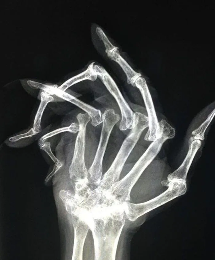 Radiografía de una mano con artritis reumatoide avanzada