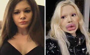 20 Extreme Plastic Surgery Journeys Of Normal People That Led To Fame