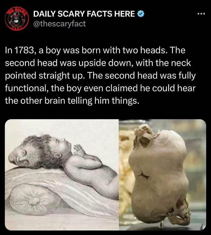 Illustration and skull of a boy born with two heads, one upside down, showcasing a rare scary fact about multiple heads.