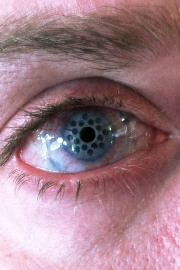 El ojo de mi tío se curó tras un trasplante de córnea